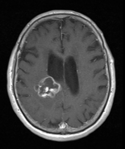 MRI showing glioma