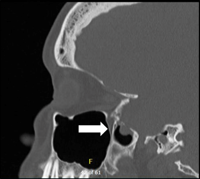 Sagittal CT scan demonstrating access through the posterior wall of the maxillary sinus (transpterygoid approach) to the lateral recess of the sphenoid (white arrow). The encephalocele can be seen protruding into the sphenoid sinus.