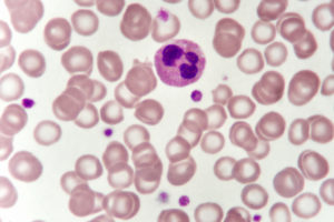 Neutrophil cell (white blood cell) in blood smear, analyze by microscope