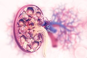 Kidney disease