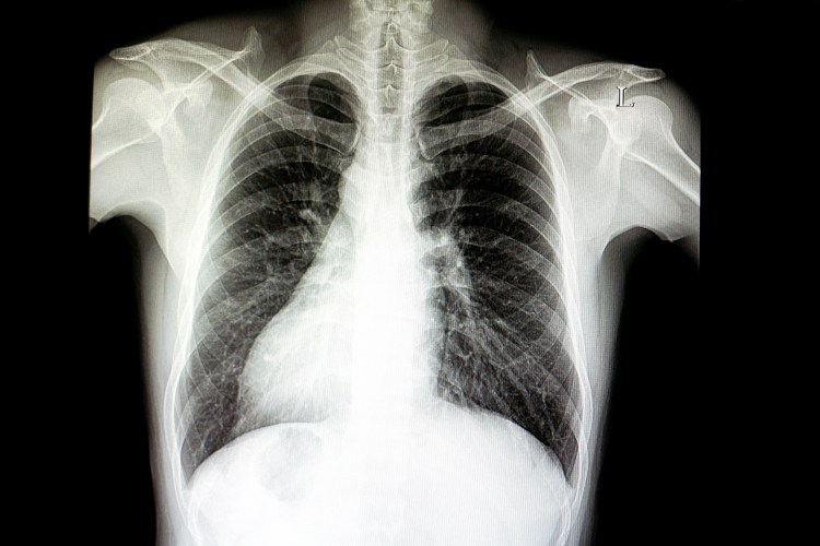 Situs inversus, a congenital condition in which the major visceral organs are reversed from normal positions. A physical examination confirmed the position of the heart.