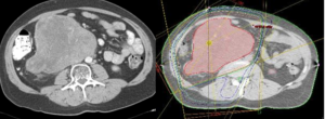 PET scan image of Retroperitoneal Sarcoma