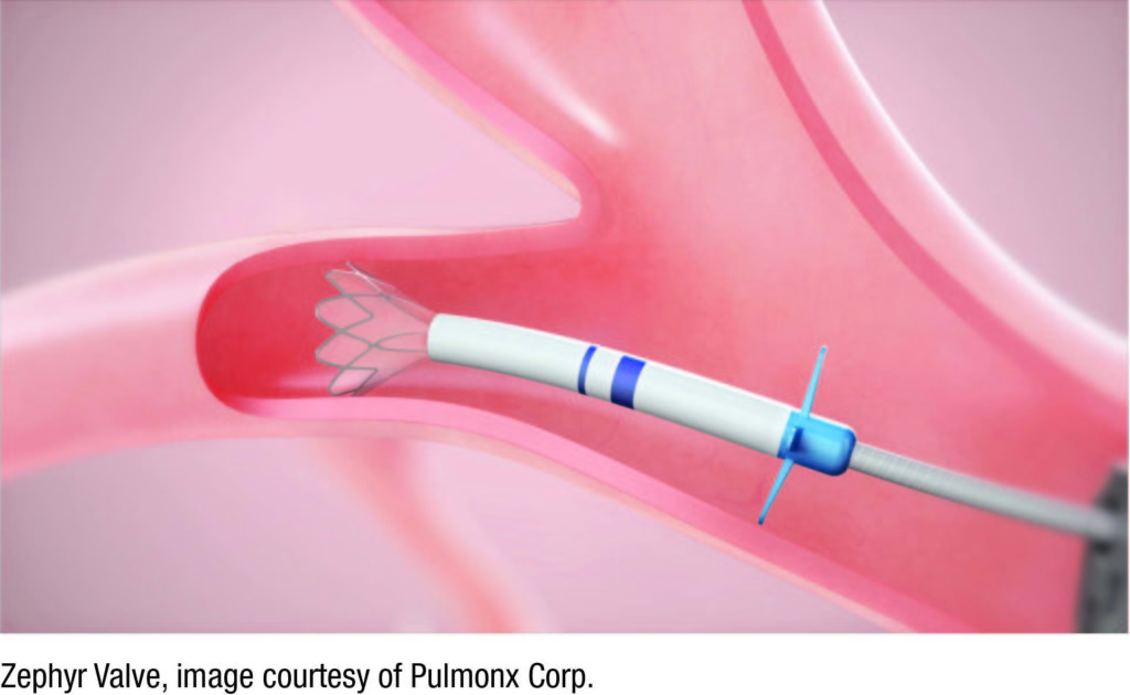 New Option for Severe Emphysema OneWay Valves to Reduce Lung Volume