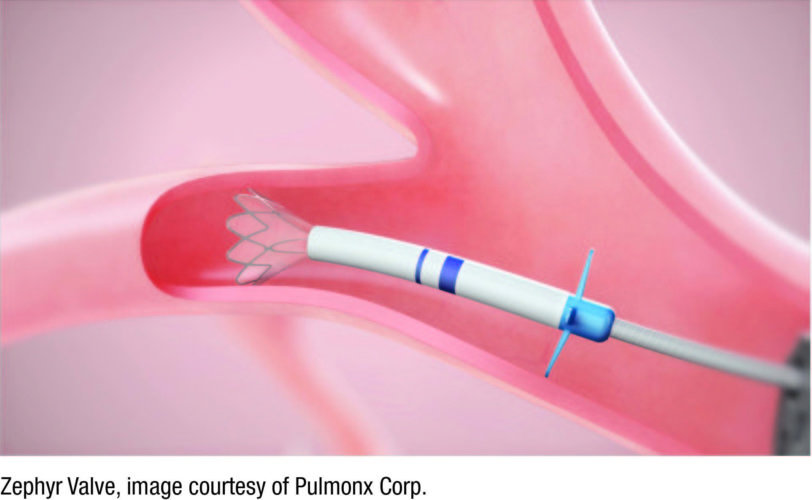 New Option For Severe Emphysema One Way Valves To Reduce Lung Volume 