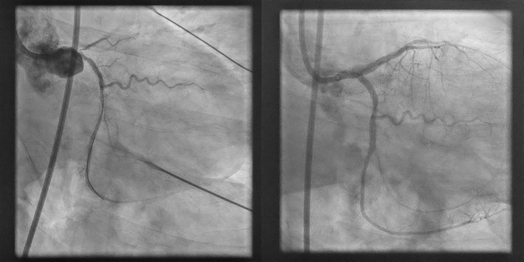 coronary arteries before and after intervention