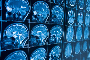 series of brain scans