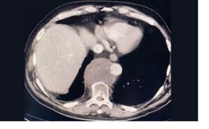 Cross-sectional view of yolk sac tumor (YST) surrounding the aorta.