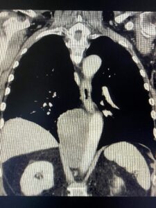 Frontal view of yolk sac tumor (YST) extending from chest to upper abdomen and surrounding the aorta.