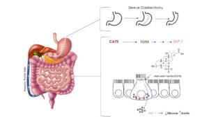 illustration showing changes after gastric surgery