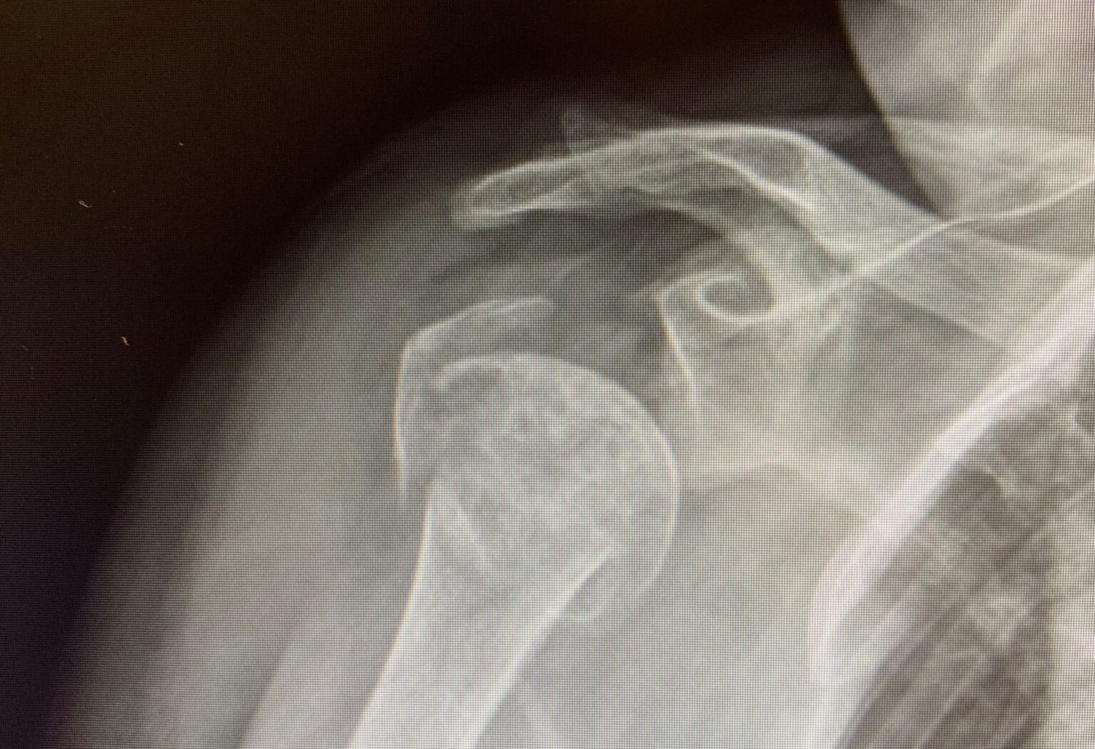 Surgery for Shoulder Fractures Not Always the Best Approach Brigham