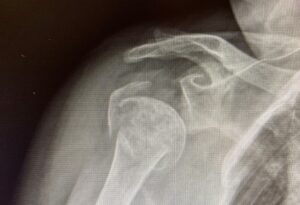 x-ray of shoulder fracture