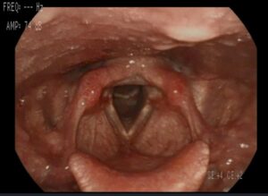Laryngopharyngeal reflux disease (LPR), an inflammatory condition related to the direct and indirect effects of gastroduodenal content reflux, affects up to 30 percent of otolaryngology patients worldwide. The condition leads to symptoms including chronic throat clearing and cough, excess throat mucus, postnasal drip and vocal changes, which can significantly impact the patient's quality of life. "Besides a small but real risk of esophageal cancer, we don't see a high rate of morbidity and mortality associated with LPR," said Thomas L. Carroll, MD, director of the Brigham and Women's Hospital Voice Program. "However, its symptoms can cause a great deal of stress and significantly impact quality of life for patients in both professional and social settings. Patients often experience a disconcerting globus sensation and even pain or discomfort, which makes swallowing during and between mealtimes distressing and effortful." According to Dr. Carroll, diagnosing LPR can be difficult because its symptoms also are encountered in other otolaryngologic conditions such as voice disorders and allergies. That is why he, along with a team of international collaborators, developed a new tool to make diagnosing LPR more reliable and easier for the clinician faced with a potential LPR patient. The Reflux Symptom Score-12 (RSS-12) was detailed in an original research paper published last year in the Journal of Otolaryngology – Head and Neck Surgery. Easing Burdens on Patients With LPR RSS-12 is a shorter version of a previous 22-question, self-administered, patient-reported outcome measure (PROM) questionnaire created by Jerome R. Lechien, MD, PhD, of Foch Hospital at the University of Paris-Saclay. "The original RSS developed by Dr. Lechien improved on previous PROM tools like the Reflux Symptom Index [RSI]," Dr. Carroll said. "However, at 22 questions in length, it was felt to be too burdensome and time-consuming for patients to complete in the clinic. In addition, questions around some of LPR's more esoteric symptoms, such as ear pain and tongue burning, don't elicit a high number of responses." In developing RSS-12, Dr. Carroll and his colleagues streamlined the original RSS by eliminating several questions and combining others. He said the changes make the questionnaire more relevant to a greater percentage of patients and gives physicians more robust results — at 85 percent or more specificity and nearly 95 percent sensitivity — with which to make a more likely LPR diagnosis and create a treatment plan. This data was based on patients who had been diagnosed with LPR using objective impedance-pH testing that diagnosed LPR when gastric liquid entered the hypopharynx. "Reflux can be overdiagnosed, especially in primary care clinics and even in specialty practices such as pulmonology, gastroenterology and otolaryngology," Dr. Carroll said. "As a result, patients may be put on medications like proton pump inhibitors, which carry some known, untoward side effects. With RSS-12, we will more accurately identify the patients who would benefit from these medications or other reflux treatments while avoiding prescribing them to patients who would better benefit from treatments or referrals directed at diagnoses other than LPR." RSS-12 Clinical Implications and Future LPR Research The Brigham started using RSS-12 in December 2020, incorporating it into its electronic patient intake system. Patient-reported reflux symptoms are automatically entered into both RSS-12 and RSI tools, allowing Dr. Carroll and his colleagues to compare the two scores. Future plans include using RSS-12 in the Brigham's Division of Gastroenterology, Hepatology and Endoscopy for patients receiving 24-hour pH impedance testing. "One of my goals is to require patients to answer as few questions as possible to obtain validated PROMs," Dr. Carroll said. "To that end, I'm working with my colleague Jennifer J. Shin, MD, SM, another otolaryngologist here at the Brigham, to see if we can cut down the length of the questionnaire even further, ideally to about three to five questions, and create a simple dashboard screen that will give us the most meaningful information we need to confidently make a diagnosis after examining the patient." Because the original RSS-12 was created in French and tested in a French patient population, Dr. Carroll is currently validating an English-language RSS-12 with U.S.-based patients. "The development and ongoing refinement of this new diagnostic tool has been a true international effort led by an unparalleled group of people, and it places the Brigham at the forefront of LPR research," he concluded.