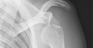 shoulder x-ray