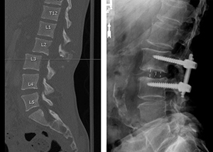 Spine X-Ray