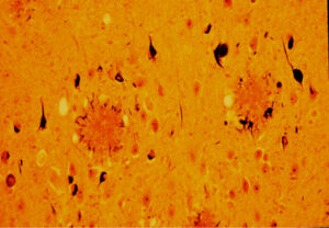 Amyloid Plaques (Ab) and Neurofibrillary Tangles (tau)