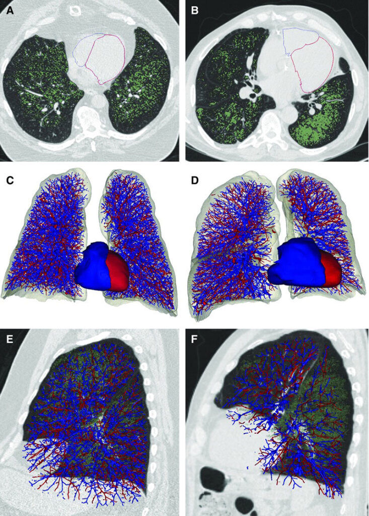 Computed tomographic examinations of emphysema 