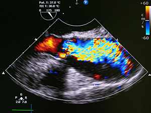 Echocardiography image doppler of aortic stenosis