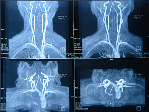 MRI non-contrast angiography of neck vessels, including internal carotid artery