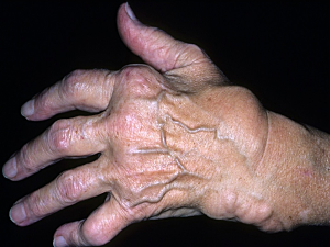Arthritic hand of a patient with rheumatoid arthritis