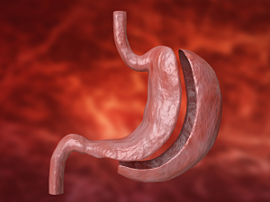 3D rendering of laparoscopic sleeve gastrectomy