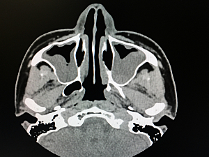 Axial plain / sagittal cut of CT scan showing inflammation of both sides maxillary sinuses