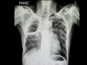 X-ray of patient with upper lung resection
