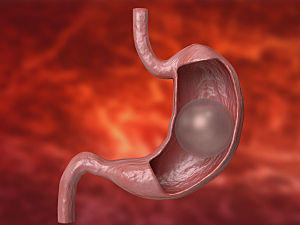 3D rendering concept of a gastric balloon inside a stomach