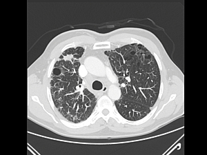 CT scan of patient with emphysema in the lungs