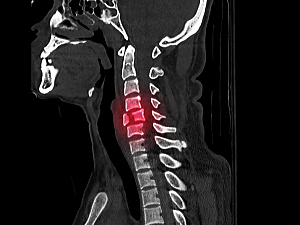 CT Scan of head and spine with a vertebral fracture highlighted in red
