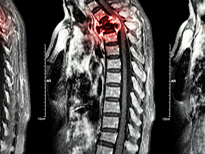 X-ray highlighting spine metastasis