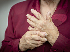 Close up of hands affected by rheumatoid arthritis