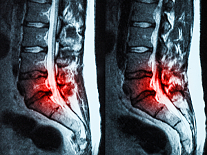 MRI of lumbar herniated disc highlighted in red