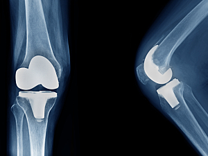 X-ray of total knee joint replacement / knee arthroplasty front view and side view