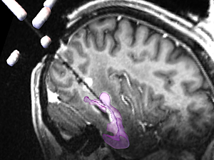 Brain MRI showing a needle inserted into a glioblastoma multiforme tumor highlighted in purple
