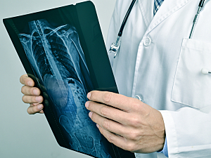 Close up of doctor holding an x-ray of the spine