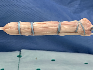Graft for ACL Reconstruction