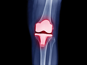 X-ray of total knee arthroplasty, highlighted in red