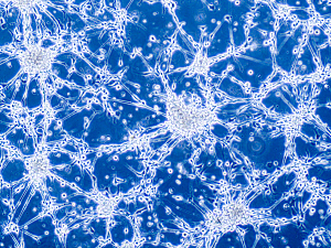 Glioblastoma brain cancer cells under microscope