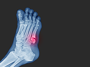 X-Ray of foot with fifth metatarsal base fracture highlighted red