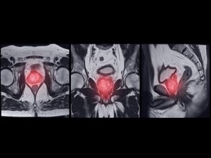 MRI image of prostate cancer