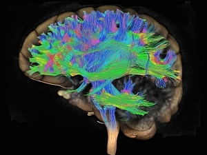 Diffusion MRI of a human brain. Brain fibers are highlighted in blue, green, yellow and pink