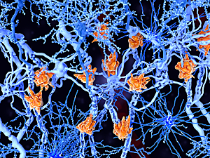 Rendering of orange microglia cells damaging the myelin sheath of neuron axons