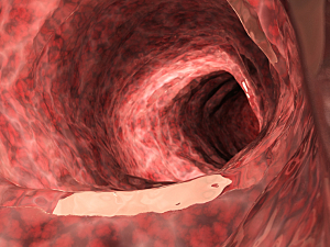Medically accurate rendering of inside an inflammed colon