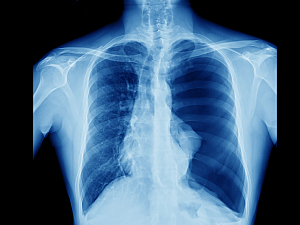 Chest x-ray showing tension pneumothorax on the left side of lung, needs chest tube drain