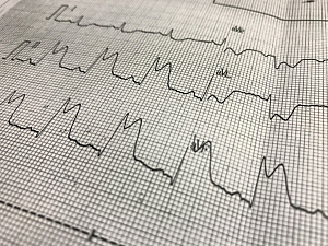 Close up of white graph paper from electrocardiogram showing ST-elevation