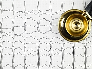 ECG heart rhythm recording on white paper showing atrial flutter, with gold stethoscope on top