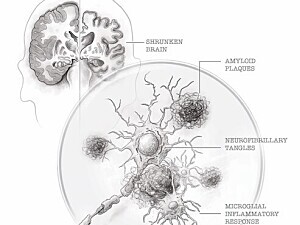 Diagram of Alzheimer's disease with amyloid plaques, neurofilbrillary tangles, and neuronal loss
