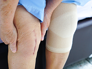 Close up of vertical scar on knee and a bandaged knee after Total Knee Arthroplasty