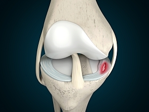 3D rendering of human knee bone and cartilage with meniscus tear highlighted red
