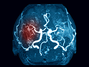 MRI of the brain, Intracerebral hemorrhages, cerebral vascular disease (stroke)